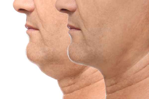 HIFU - Breakthrough in Anti - ageing 2 hifu results Sunbury