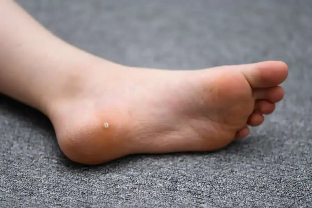 Cryotherapy For Warts And Also Verrucas 2 Image of verruca on the bottom of the foot that able to be treated with Cryotherapy Sunbury