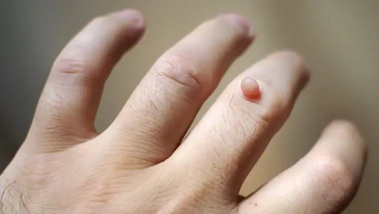 Cryotherapy For Warts And Also Verrucas 1 Image of blemish that Cryotherapy Sunbury can remove with Lipo 360.