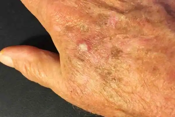 Image of Actinic keratoses Sunbury on a person hand